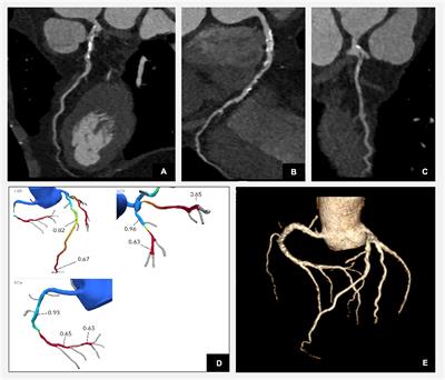 Multi-modality cardiac imaging in the management of diabetic heart disease